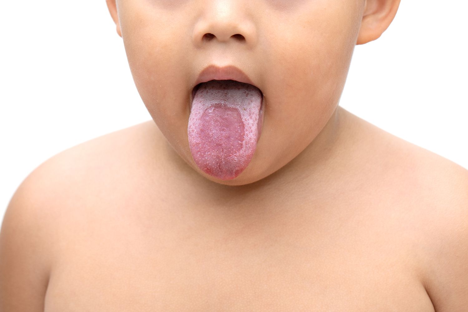 Oral candidiasis in children 2