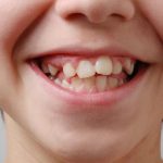 کج در آمدن دندان های دائمی کودکان