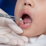 با کشیدن دندان شیری چه اتفاقی می افتد ؟