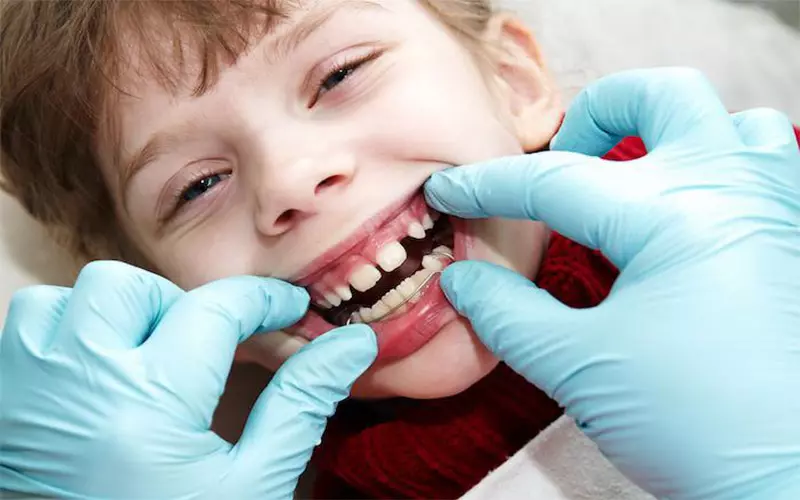 The distance between children's milk teeth 1